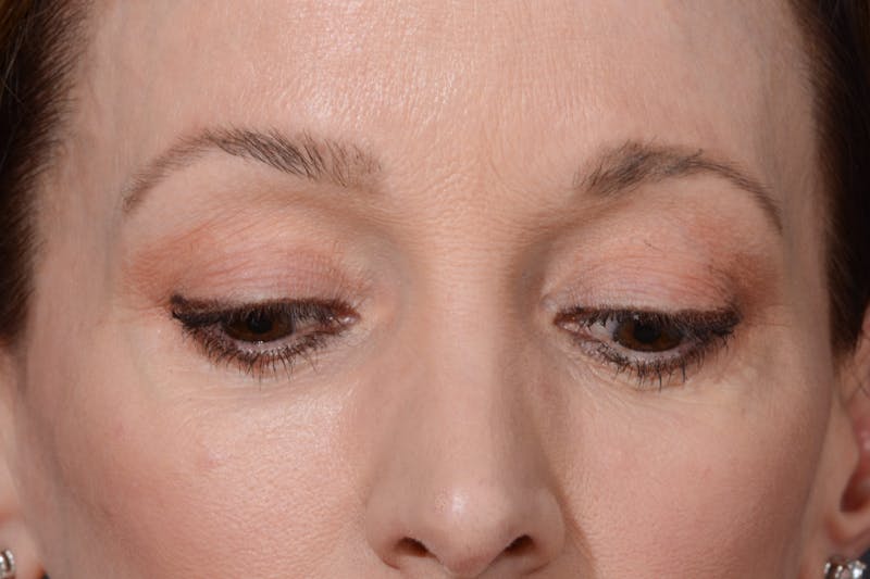 Blepharoplasty Before & After Gallery - Patient 140123277 - Image 6