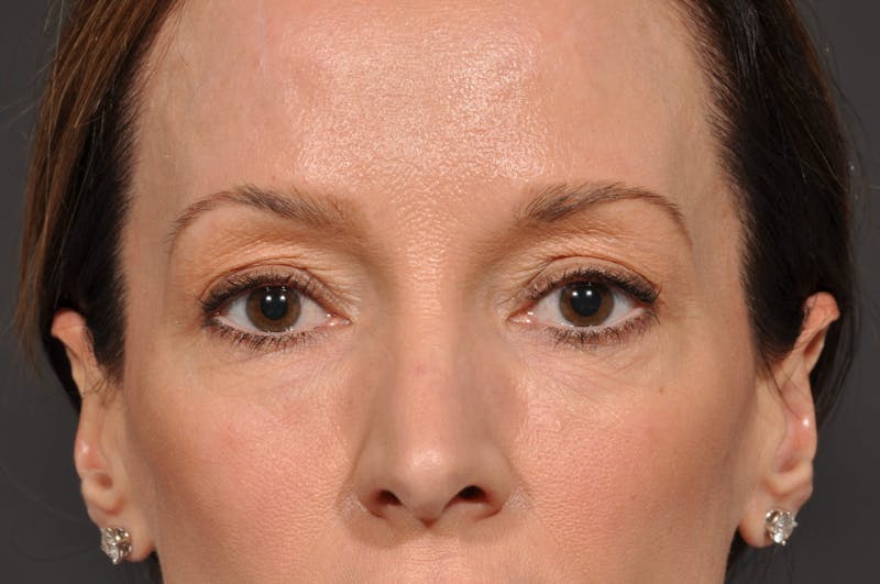 Blepharoplasty Before & After Gallery - Patient 140123277 - Image 1