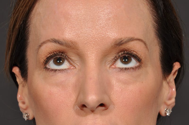 Blepharoplasty Before & After Gallery - Patient 140123277 - Image 3