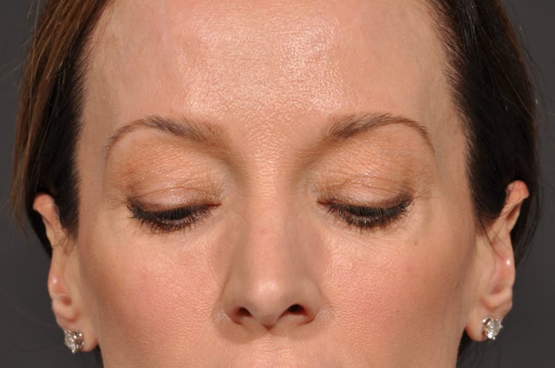 Blepharoplasty Before & After Gallery - Patient 140123277 - Image 5