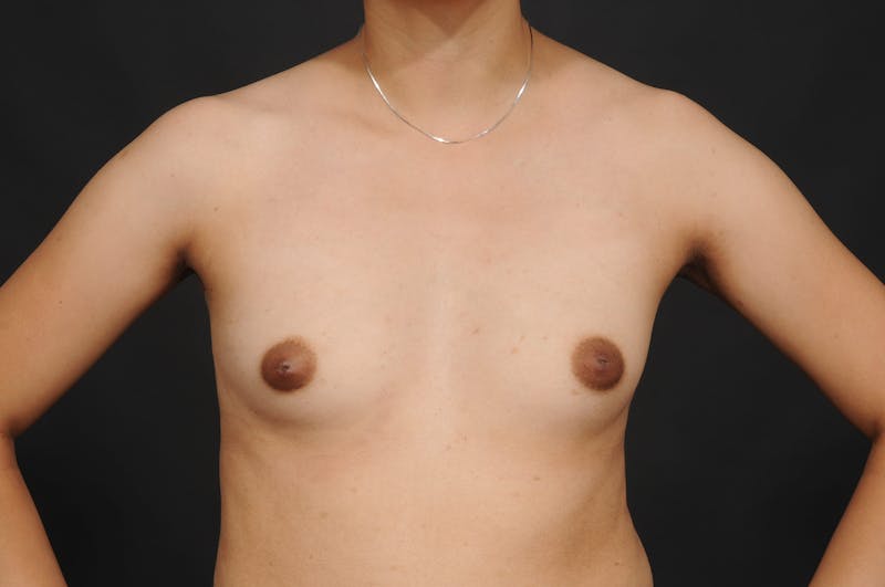 Breast Augmentation Before & After Gallery - Patient 140131031 - Image 3