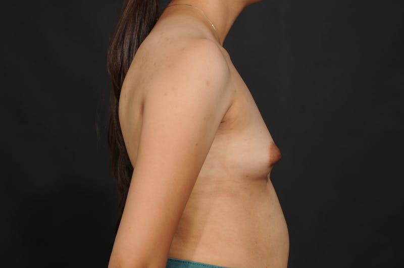 Breast Augmentation Before & After Gallery - Patient 140131031 - Image 11