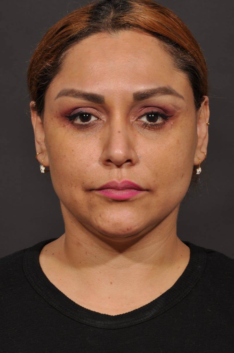 Facelift Before & After Gallery - Patient 140131079 - Image 2