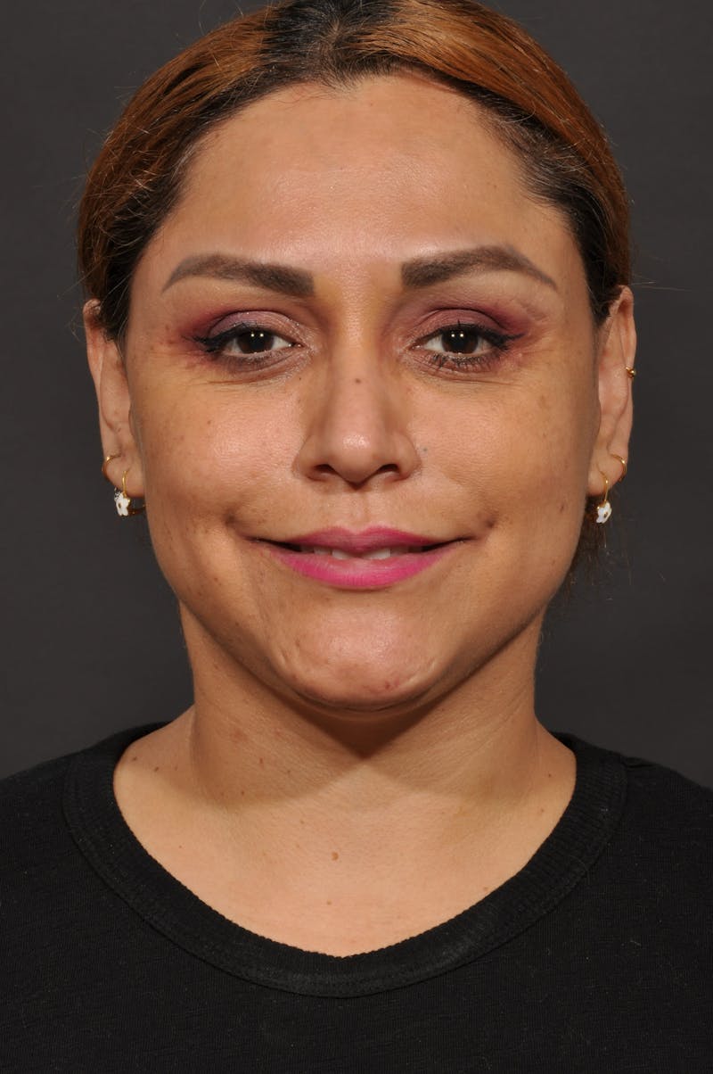 Facelift Before & After Gallery - Patient 140131079 - Image 4