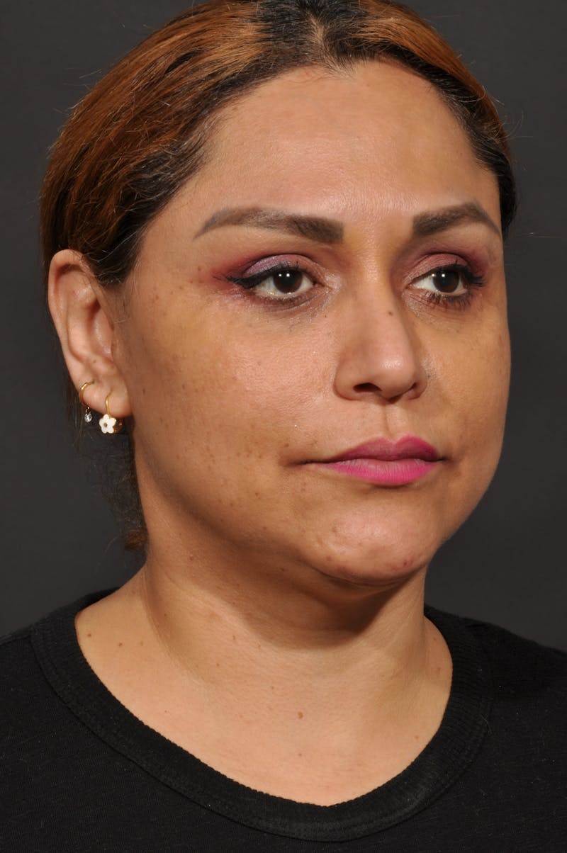 Facelift Before & After Gallery - Patient 140131079 - Image 6