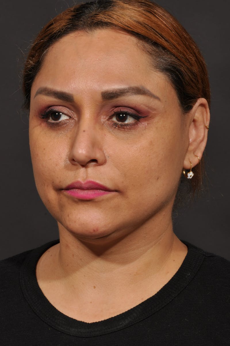 Facelift Before & After Gallery - Patient 140131079 - Image 8