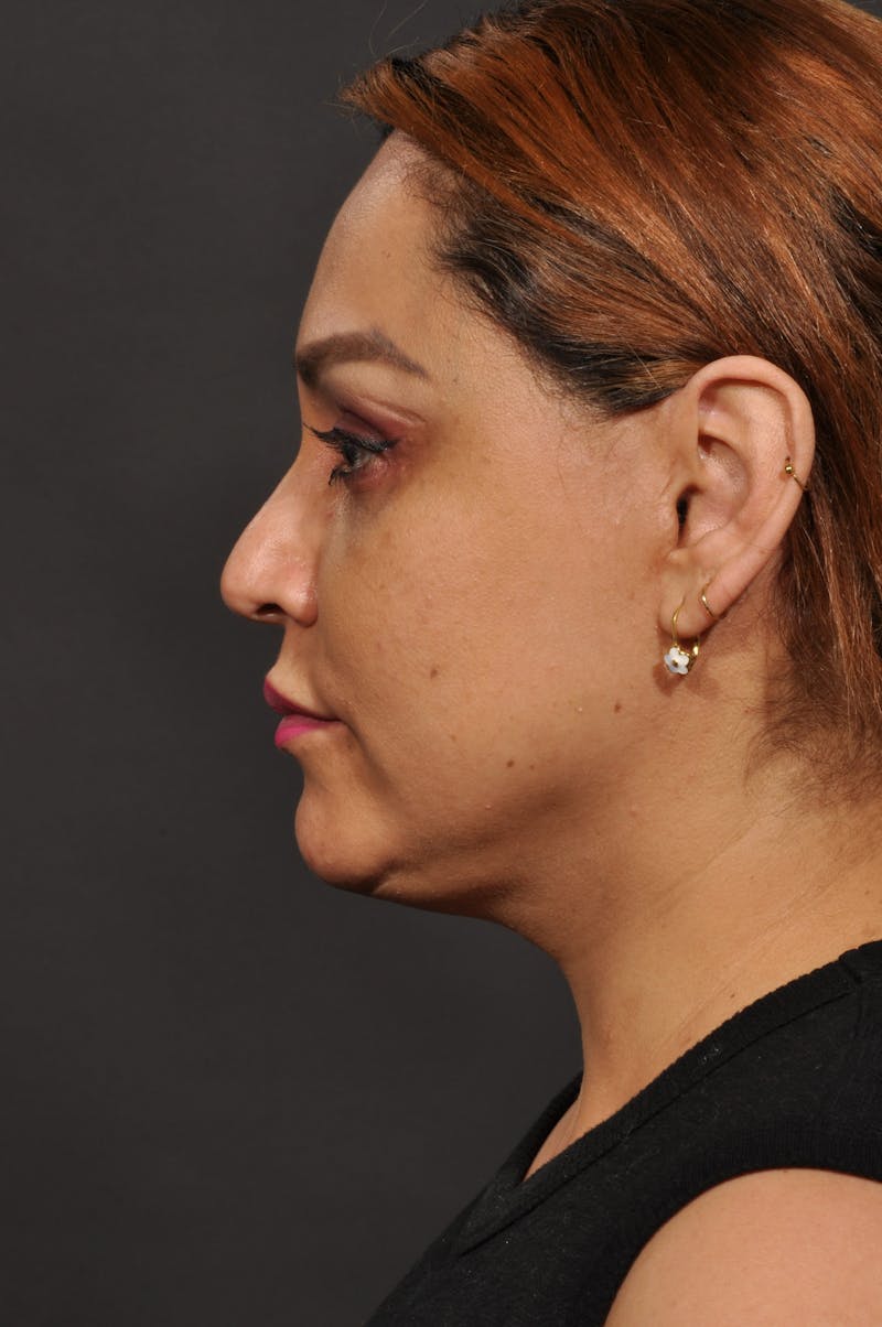 Facelift Before & After Gallery - Patient 140131079 - Image 10