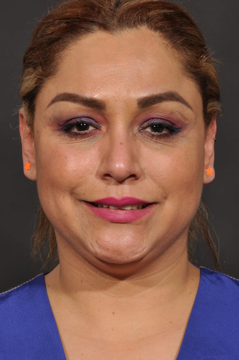 Facelift Before & After Gallery - Patient 140131079 - Image 3