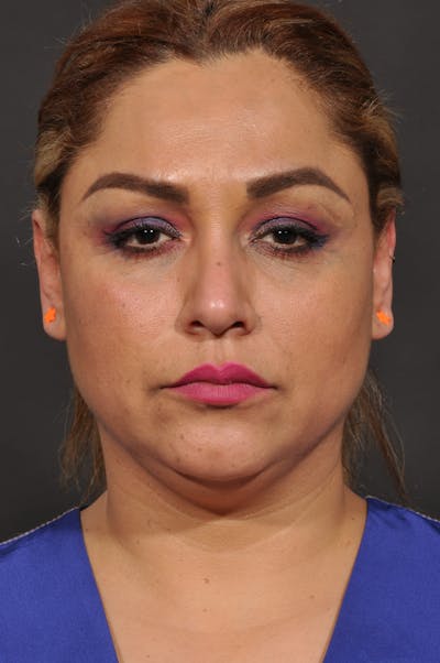 Facelift Before & After Gallery - Patient 140131079 - Image 1