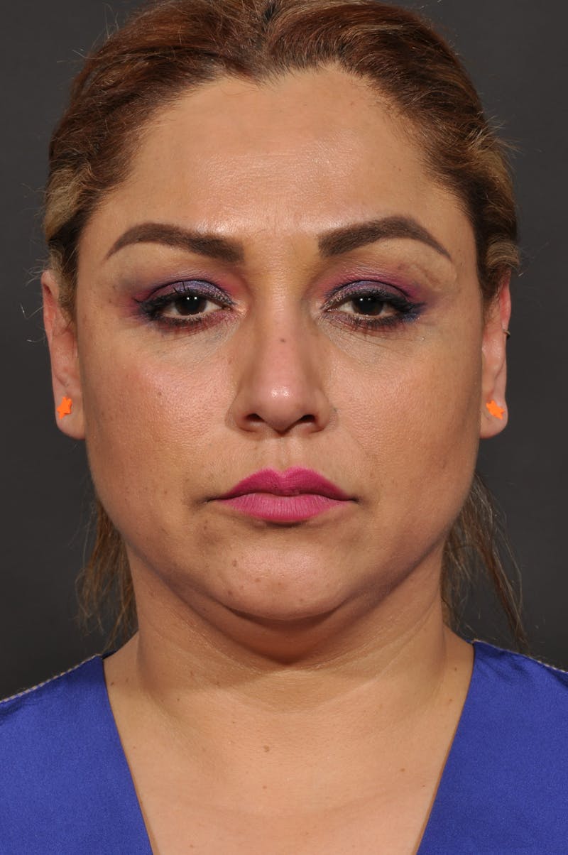 Facelift Before & After Gallery - Patient 140131079 - Image 1