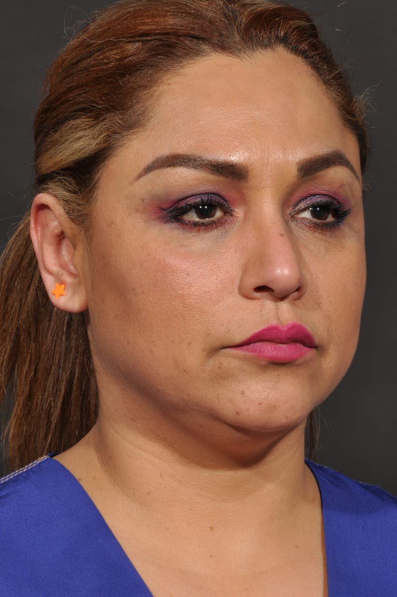 Facelift Before & After Gallery - Patient 140131079 - Image 5