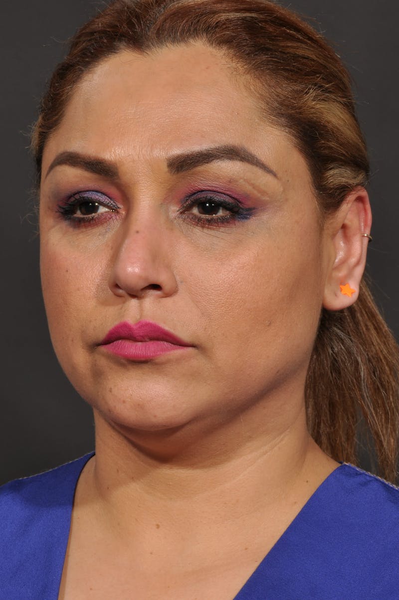 Facelift Before & After Gallery - Patient 140131079 - Image 7