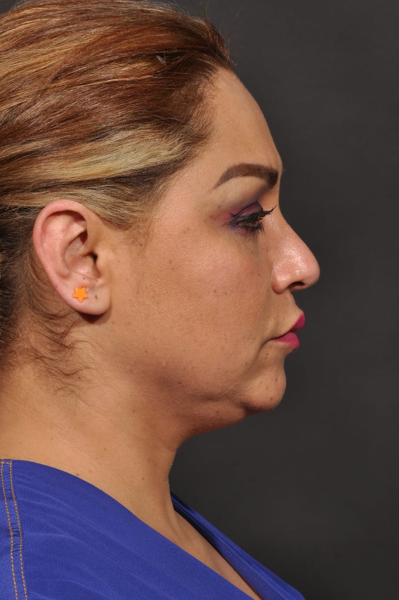 Facelift Before & After Gallery - Patient 140131079 - Image 11