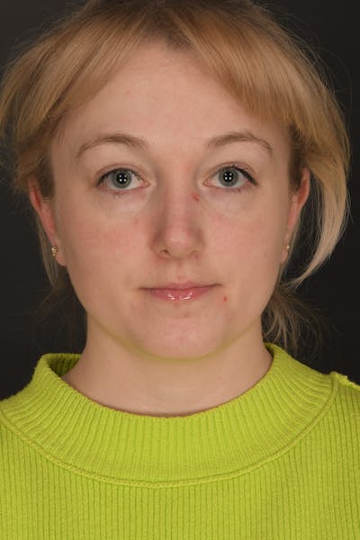 Rhinoplasty Before & After Gallery - Patient 140134325 - Image 2