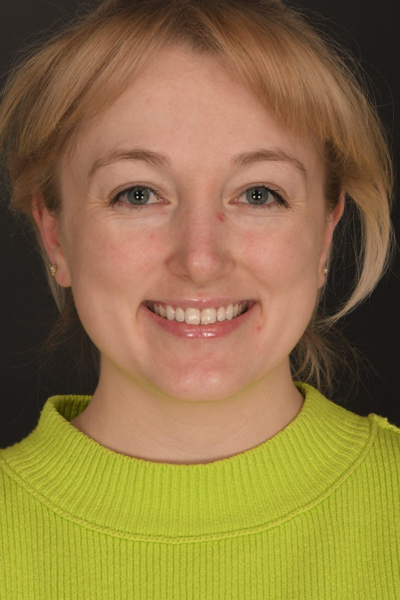 Rhinoplasty Before & After Gallery - Patient 140134325 - Image 4