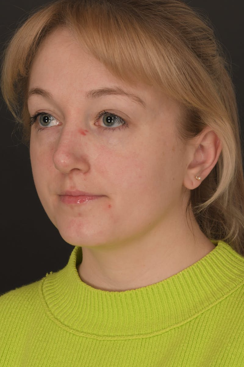 Rhinoplasty Before & After Gallery - Patient 140134325 - Image 8