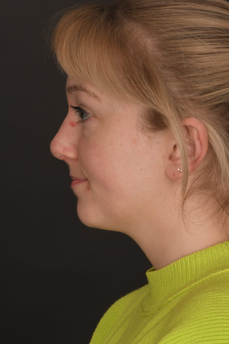 Rhinoplasty Before & After Gallery - Patient 140134325 - Image 10