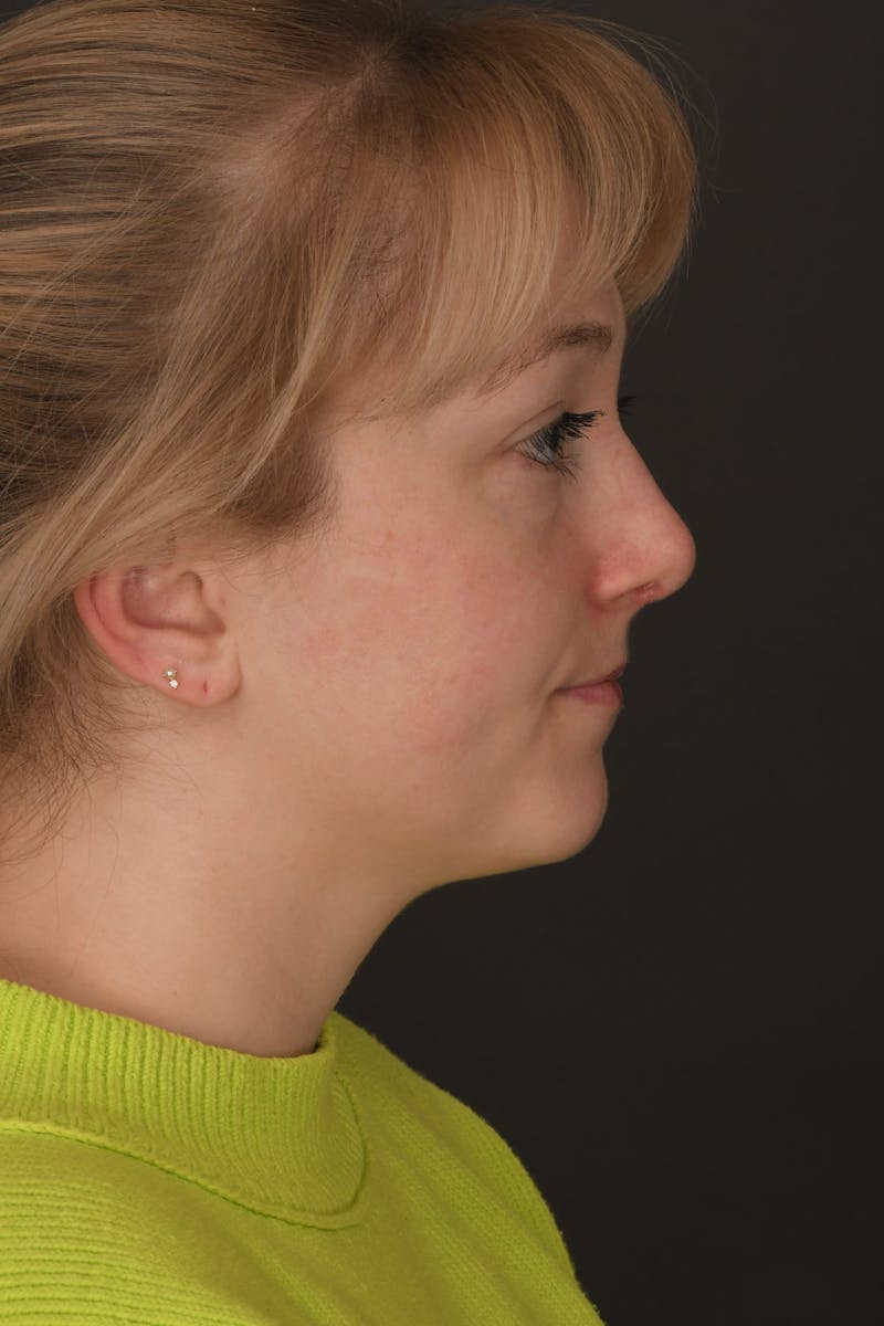 Rhinoplasty Before & After Gallery - Patient 140134325 - Image 12