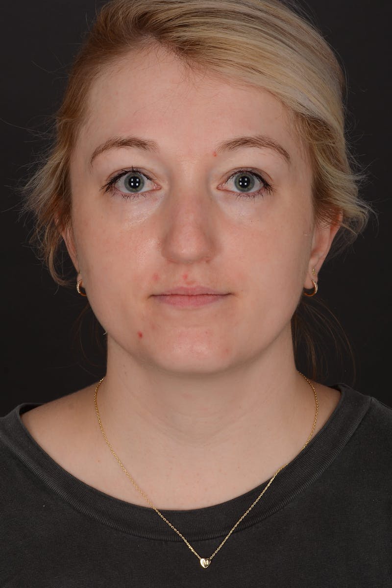 Rhinoplasty Before & After Gallery - Patient 140134325 - Image 1