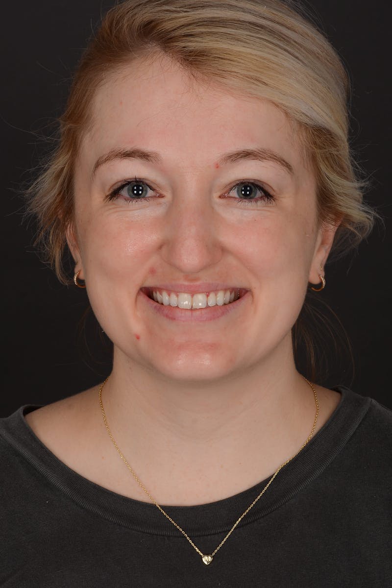 Rhinoplasty Before & After Gallery - Patient 140134325 - Image 3