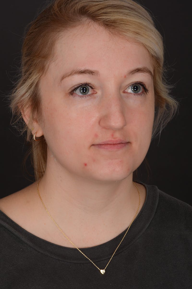 Rhinoplasty Before & After Gallery - Patient 140134325 - Image 5