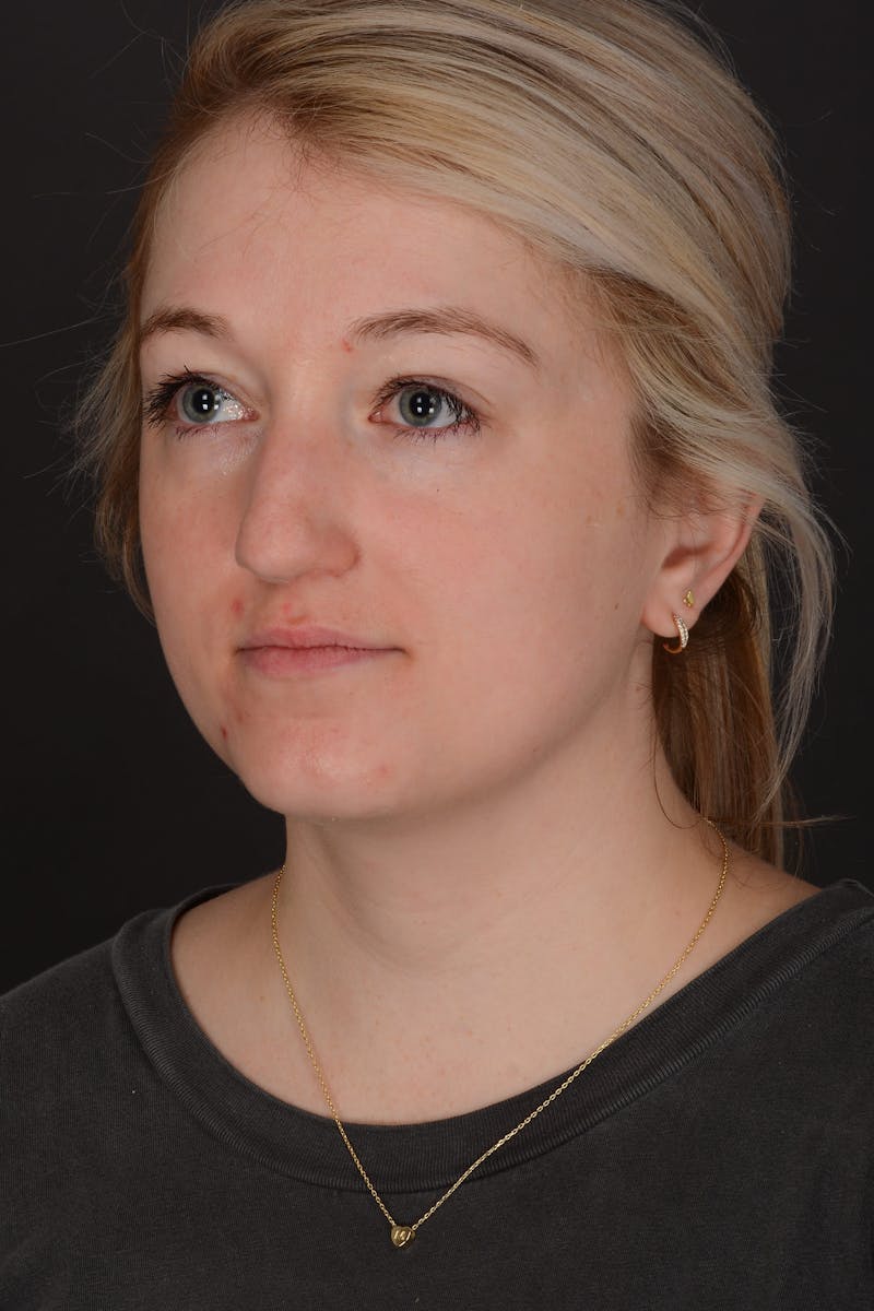 Rhinoplasty Before & After Gallery - Patient 140134325 - Image 7