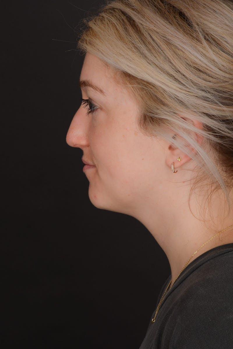 Rhinoplasty Before & After Gallery - Patient 140134325 - Image 9