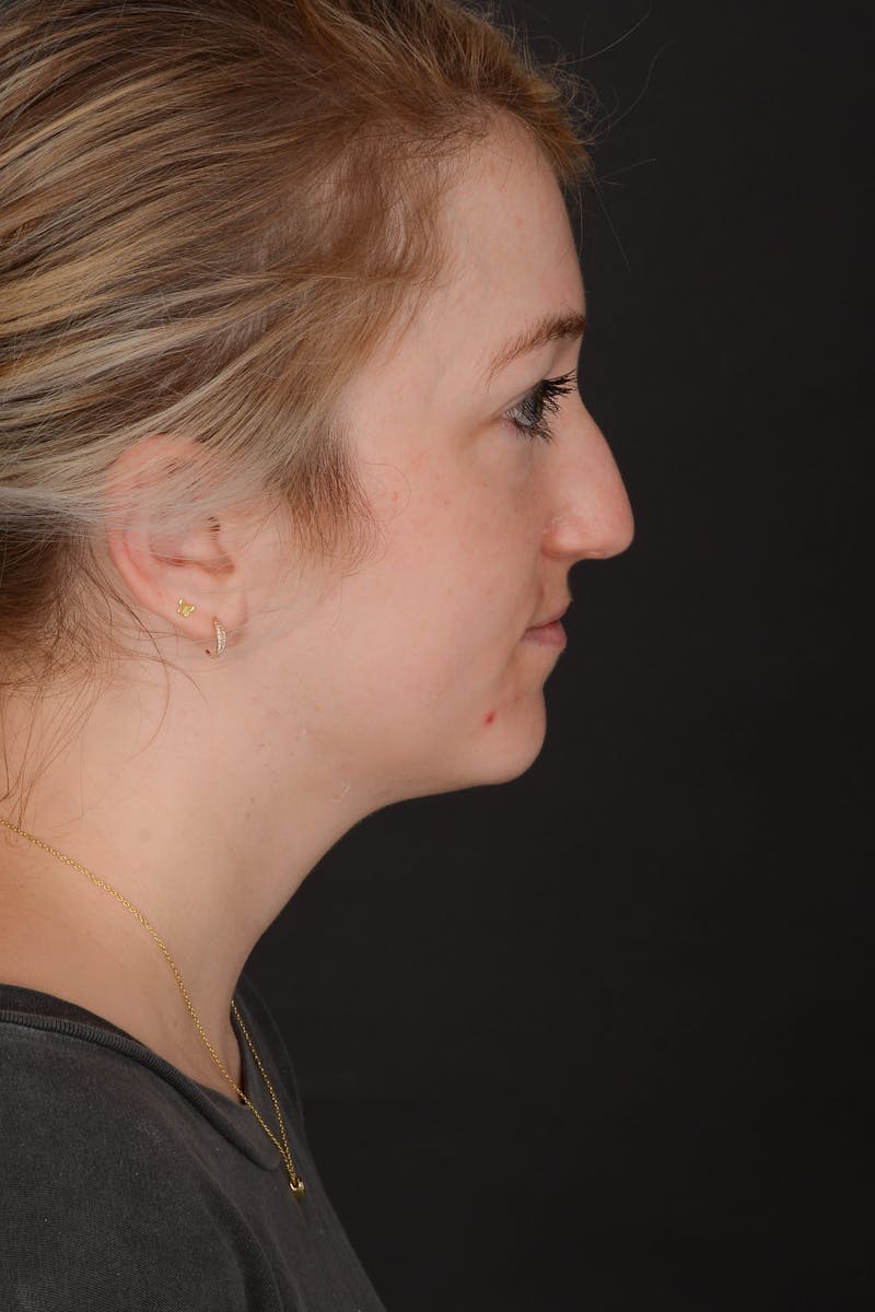 Rhinoplasty Before & After Gallery - Patient 140134325 - Image 11