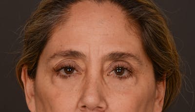 Blepharoplasty Before & After Gallery - Patient 140134405 - Image 1
