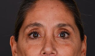 Blepharoplasty Before & After Gallery - Patient 140134405 - Image 2