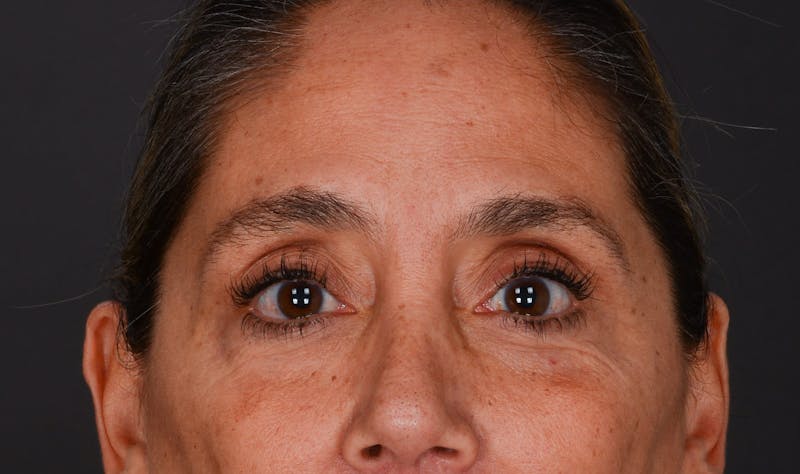 Blepharoplasty Before & After Gallery - Patient 140134405 - Image 2