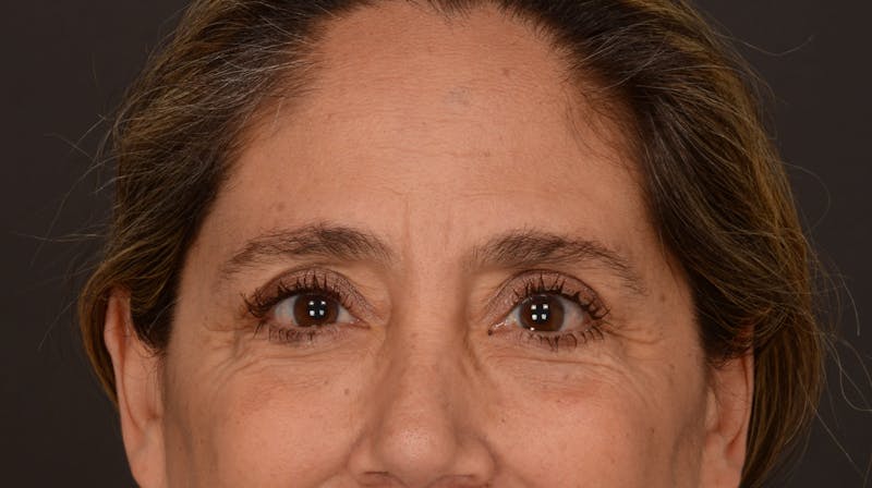 Blepharoplasty Before & After Gallery - Patient 140134405 - Image 3