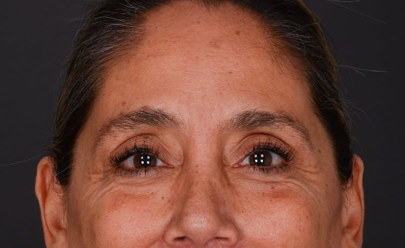 Blepharoplasty Before & After Gallery - Patient 140134405 - Image 4