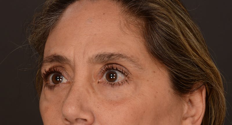 Blepharoplasty Before & After Gallery - Patient 140134405 - Image 5