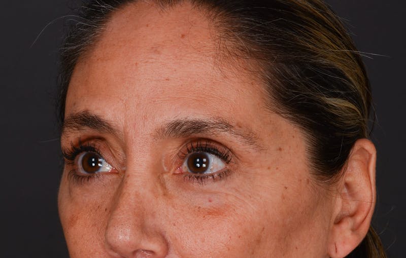 Blepharoplasty Before & After Gallery - Patient 140134405 - Image 6
