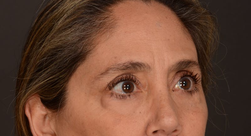 Blepharoplasty Before & After Gallery - Patient 140134405 - Image 7