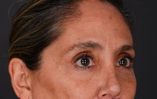 Blepharoplasty Before & After Gallery - Patient 140134405 - Image 8