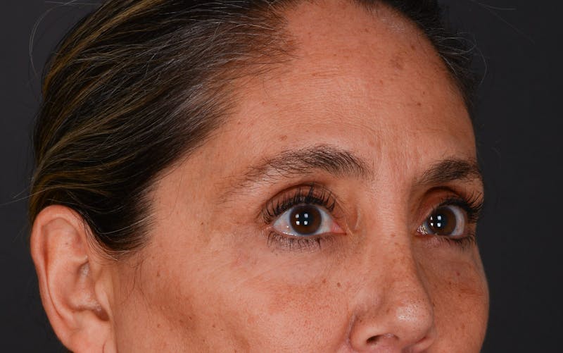 Blepharoplasty Before & After Gallery - Patient 140134405 - Image 8