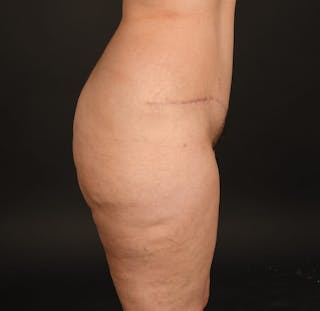 Tummy Tuck Before & After Gallery - Patient 140134430 - Image 6