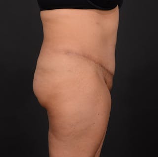 Tummy Tuck Before & After Gallery - Patient 140134450 - Image 6