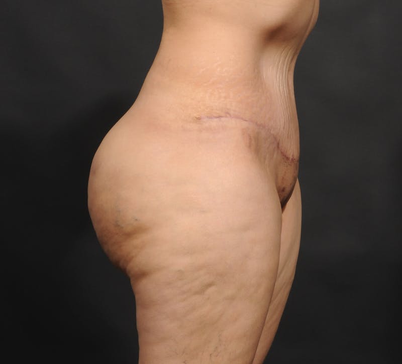 Tummy Tuck Before & After Gallery - Patient 140134477 - Image 6