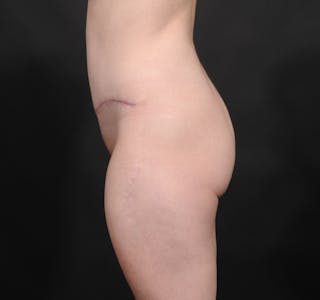 Tummy Tuck Before & After Gallery - Patient 140134505 - Image 10