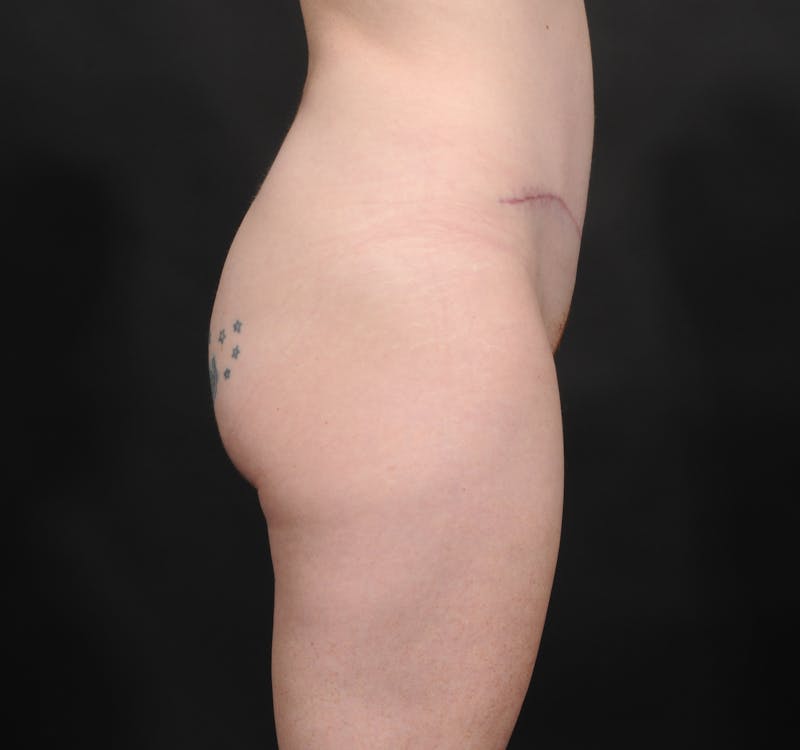 Tummy Tuck Before & After Gallery - Patient 140134505 - Image 12