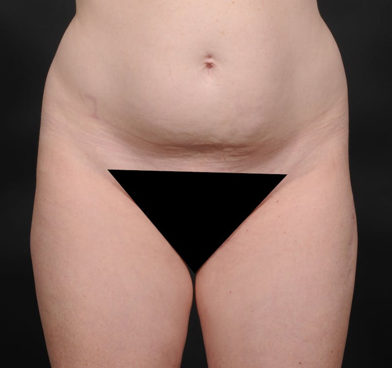 Tummy Tuck Before & After Gallery - Patient 140134505 - Image 1