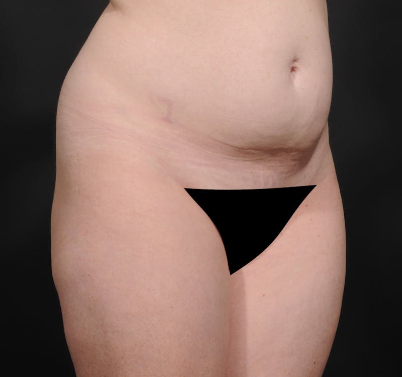 Tummy Tuck Before & After Gallery - Patient 140134505 - Image 3