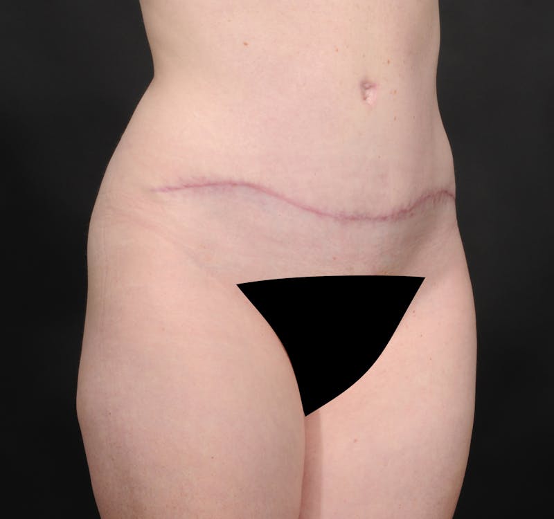 Tummy Tuck Before & After Gallery - Patient 140134505 - Image 4