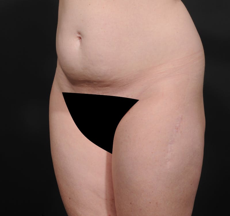 Tummy Tuck Before & After Gallery - Patient 140134505 - Image 5