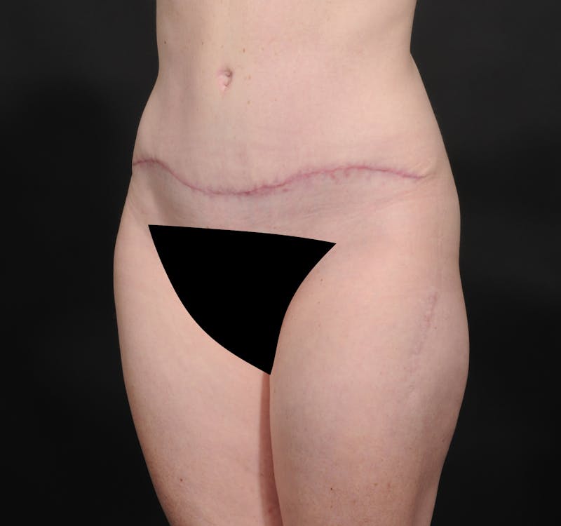 Tummy Tuck Before & After Gallery - Patient 140134505 - Image 6