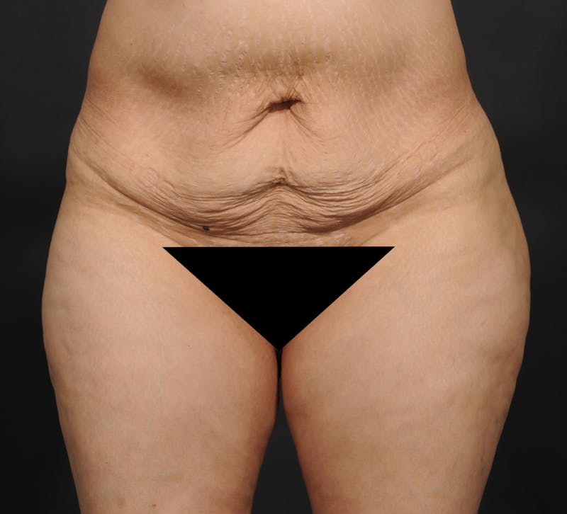 Tummy Tuck Before & After Gallery - Patient 140134477 - Image 1