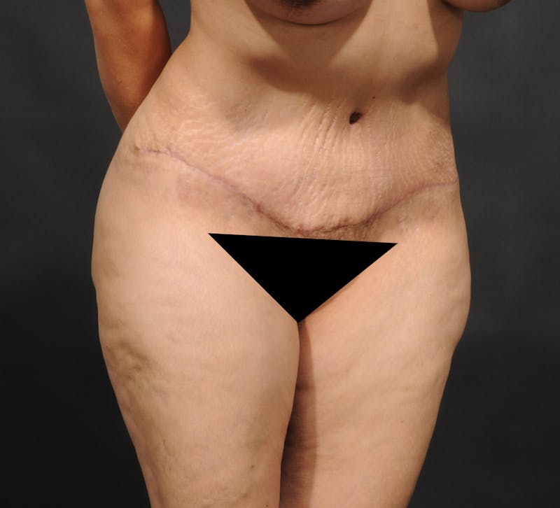 Tummy Tuck Before & After Gallery - Patient 140134477 - Image 4